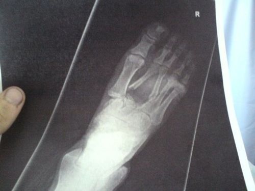 foot_puncture_injury_06